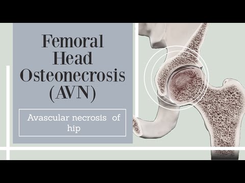 Femoral Head Osteonecrosis (AVN) - Avascular necrosis  of hip
