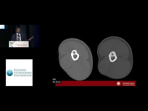 Alessandro Napoli - MRgFUSin the management of Osteoid Osteoma (2018)
