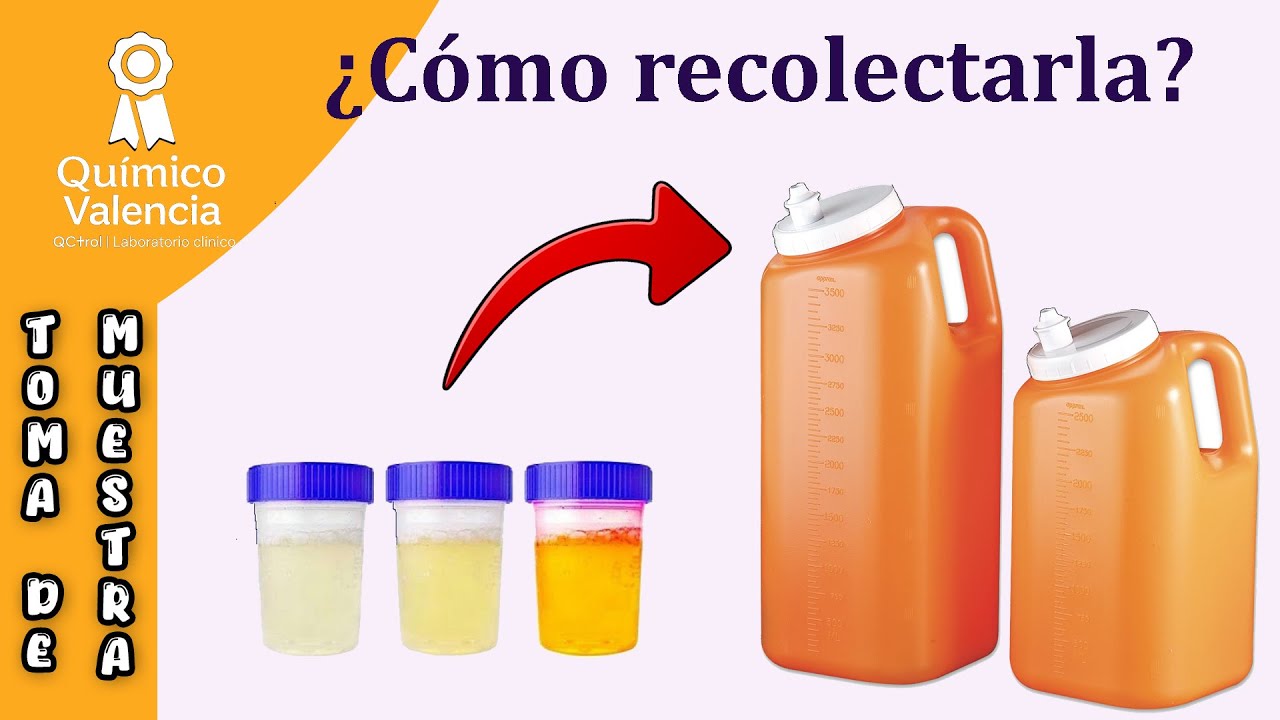Watch ¿Cómo se recolecta la orina de 24 horas Now ¿Cómo se recolecta la orina de 24 horas