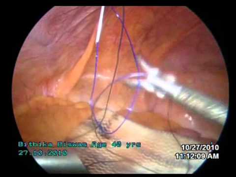 laparoscopic umbillical henia repair with proceed mesh and endo tacker