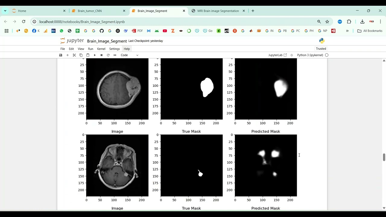 MRI Brain Image Segmentation using CNN in Python Projects