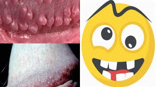 How to Remove Pearly Penile Papules in 3 Days
