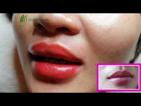 Cấy môi sinh học collagen