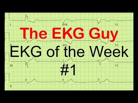 EKG/ECG of the Week #1 | The EKG Guy - www.ekgguy.com