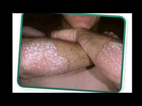 Perché cè un prurito a eczema Mele allatto di cura di eczema
