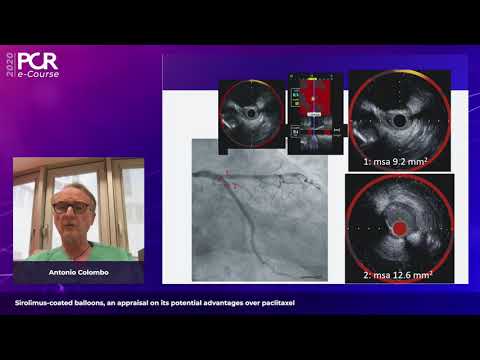 Sirolimus-coated balloons, an appraisal on its potential advantages over paclitaxel