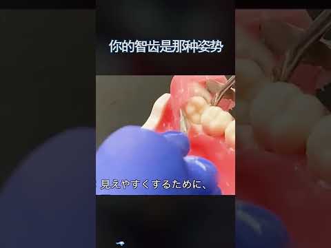 下排牙齒歪斜