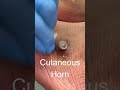 Cutaneous Horn Watch The Removal On My Channel Cutaneoushorn Feet Podiatry Footcare