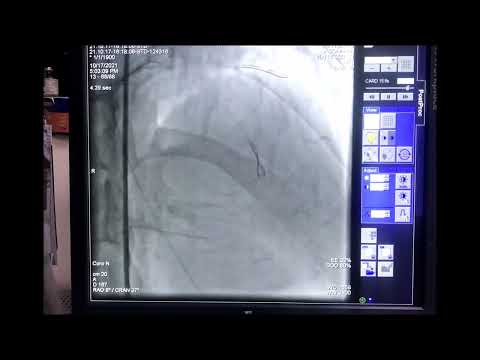 CASE 2 - PRIMARY PCI TO LAD HAVING SUDDEN CARDIAC ARREST