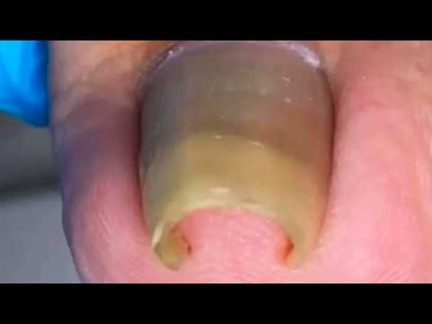 Super Curly Toenails, Unexpectedly Hard When Trimmed~【Crazy pedicure room】