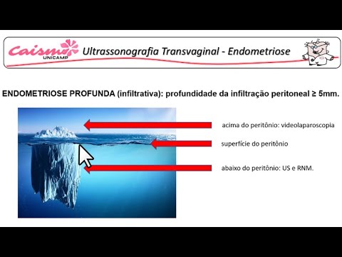 Ultrassonografia transvaginal na endometriose profunda
