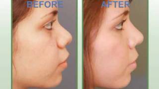 Narrowing Nose With Rhinoplasty