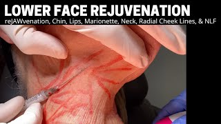Lower Face Rejuvenation - reJAWvenation, Chin, Lips, Marionette, Neck, Radial Cheek Lines, & NLF