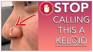 STOP CALLING BUMPS ON YOUR PIERCING KELOIDS!!