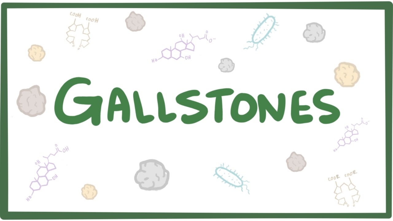 Gallstones (cholelithiasis)