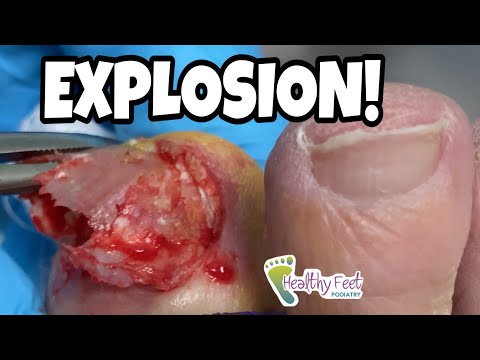 BIG TOE READY TO EXPLODE!  WATCH WHAT HAPPENS NEXT!