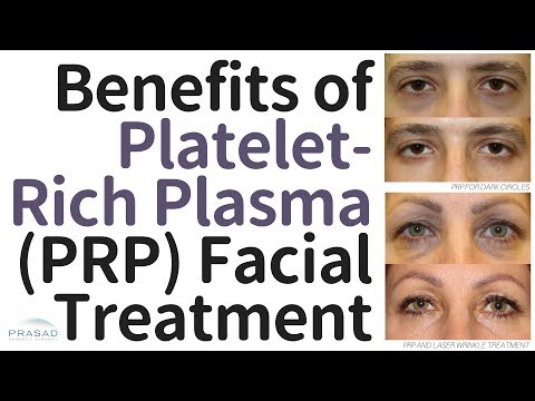 Benefits of Platelet-Rich Plasma (PRP) Facial Treatment, and Why the Vampire Facelift® is Different