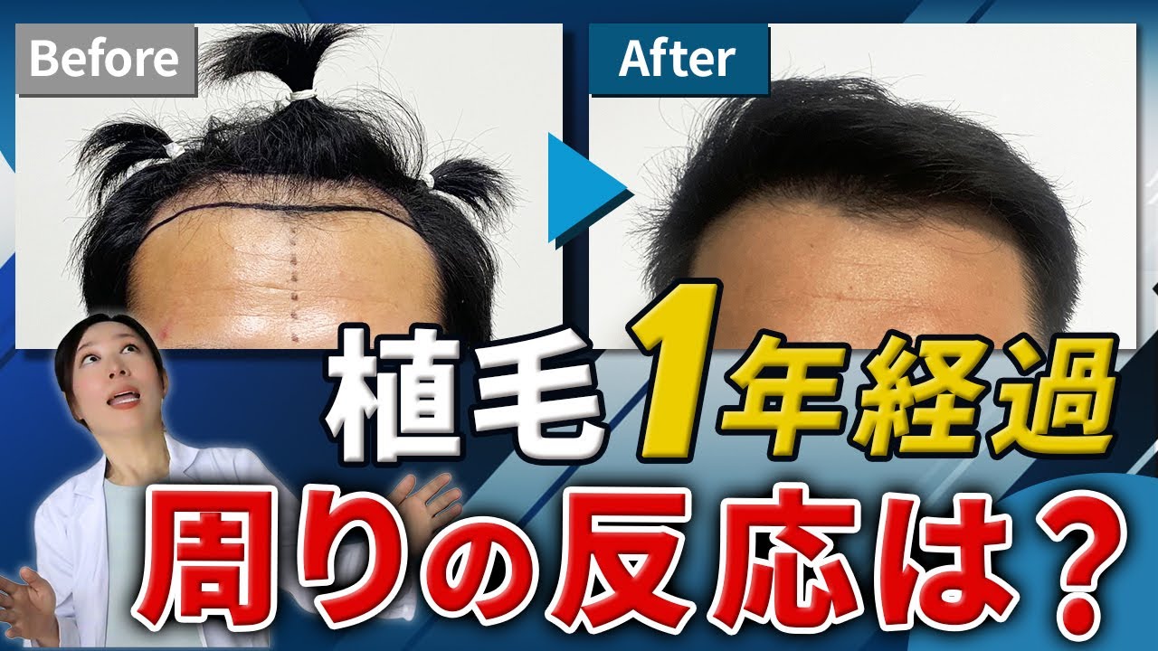 【トルコ植毛から1年】実際どうなった？DHI法・約2800株の体験談