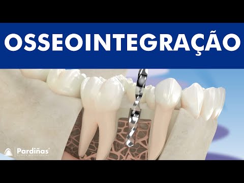 A osseointegração do implante dentário ©