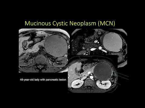Cystic Pancreatic Lesions