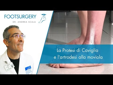 Osteocondrosi toracica quanti vivono Herbalife per le articolazioni