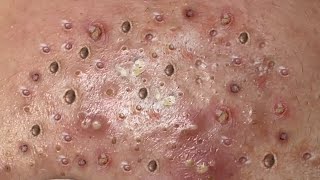 Loan Nguyen Acne Treatment 1m