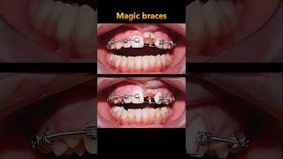 Magic braces. Pulling impacted teeth process #braces #dentist #orthodontist #brackets