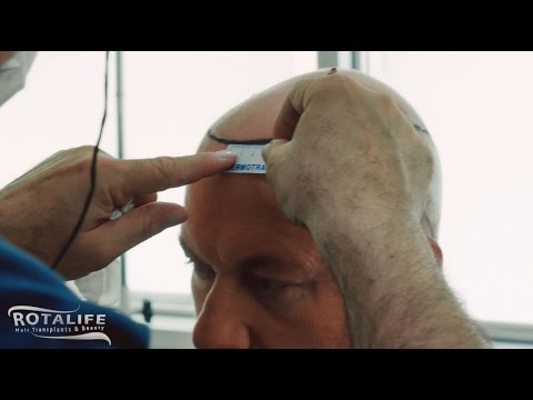 ROTALIFE – Hair Transplant Turkey
