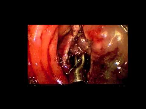 Endoscopic and Surgical Approach to Retrieve a Retained Foreign Body