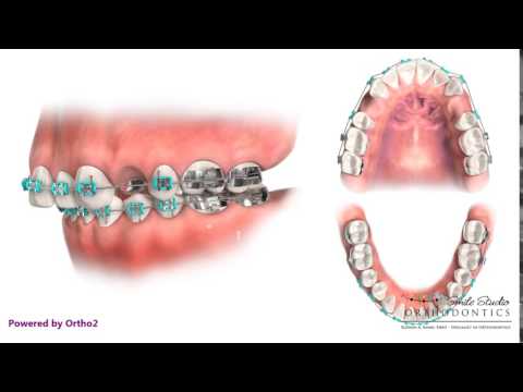 Upper 1st Premolar Extraction