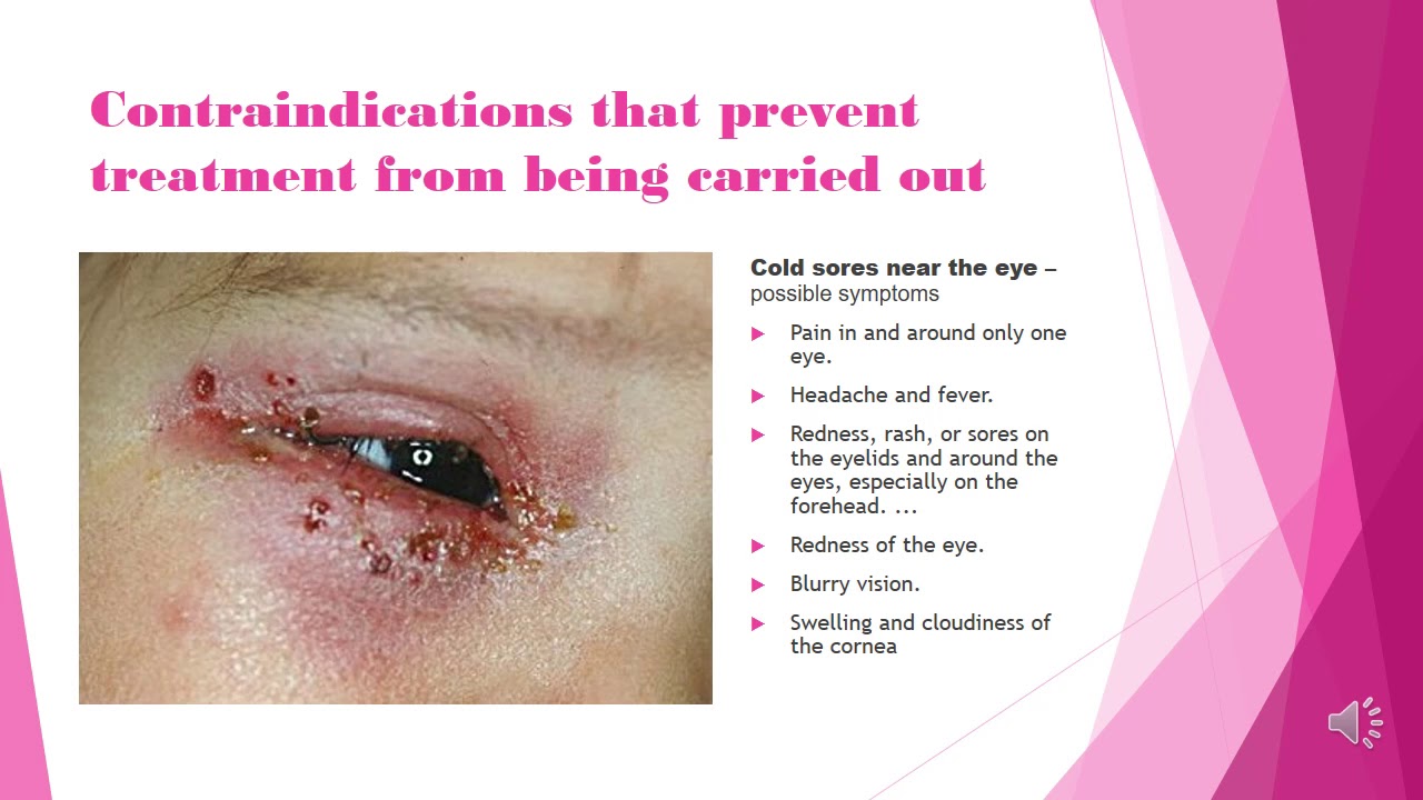 Watch video Common Contraindications and Contra actions to eyelash treatments Now Common Contraindications and Contra actions to eyelash treatments