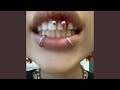 BLOOD ON THE TEETH (feat. PINKBLXXD)