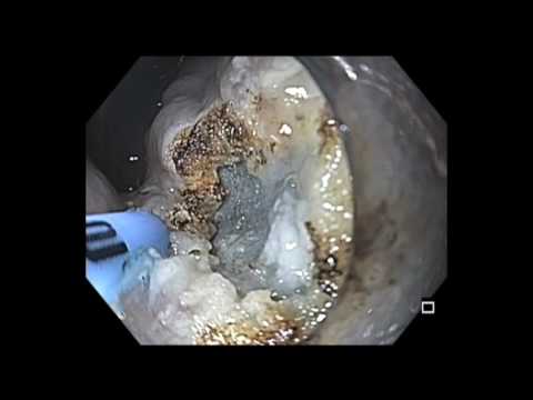 Colonoscopy: EMR of a Rectal Cancer in an Adenoma