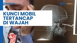 Wanita Asal Kanada Ini Tak Sadar Ada Kunci Mobil Tertancap di Wajahnya, Mengaku Tak Kesakitan
