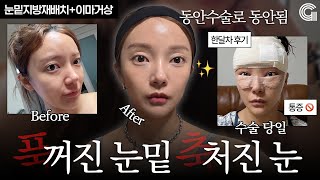 푹 꺼진 눈밑 축 처진 눈.. 동안수술로 동안됨!