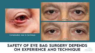 How Eye Bag Removal Surgery/ Lower Blepharoplasty is Done More Safely
