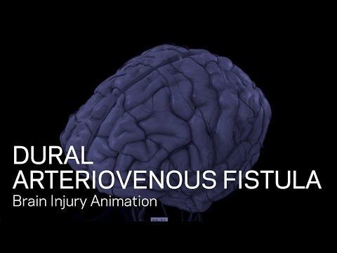 Normal Vascular Anatomy and Dural Arteriovenous Fistula (DAVF)
