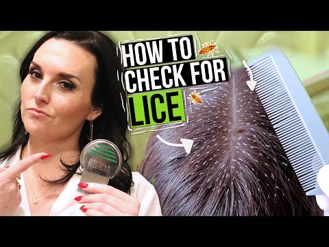How to Check for Lice - 5 Lice Treatment Tips from a Professional