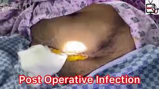 Infected Wound || Post Operative Infection || Gazi TV