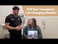 Tatiana was experiencing hair loss on her crown area and had decided to come to Hair By Dr. Max for her hair transplant.