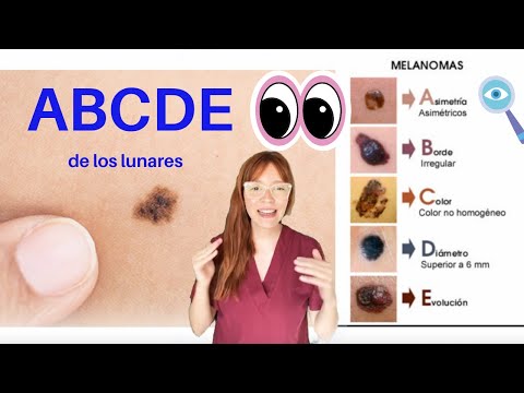 ABCDE de los lunares