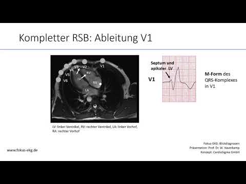 Fokus-EKG Blickdiagnosen: Rechtsschenkelblock