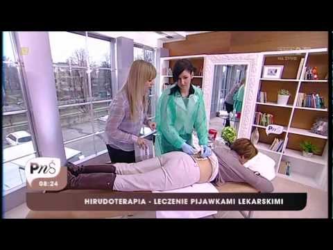 tratamentul pelvisului mic de varicoza în daca pierdei în greutate varicoza