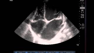 14yo Girl with Chest Pain