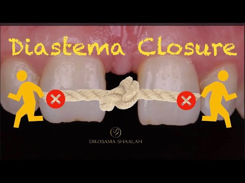 Diastema Closure Using Direct Bonding