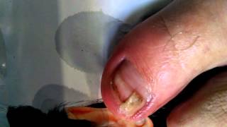 Sacar la uña enterrada en la carne. Uñas encarnadas, enterradas. ingrown toenails