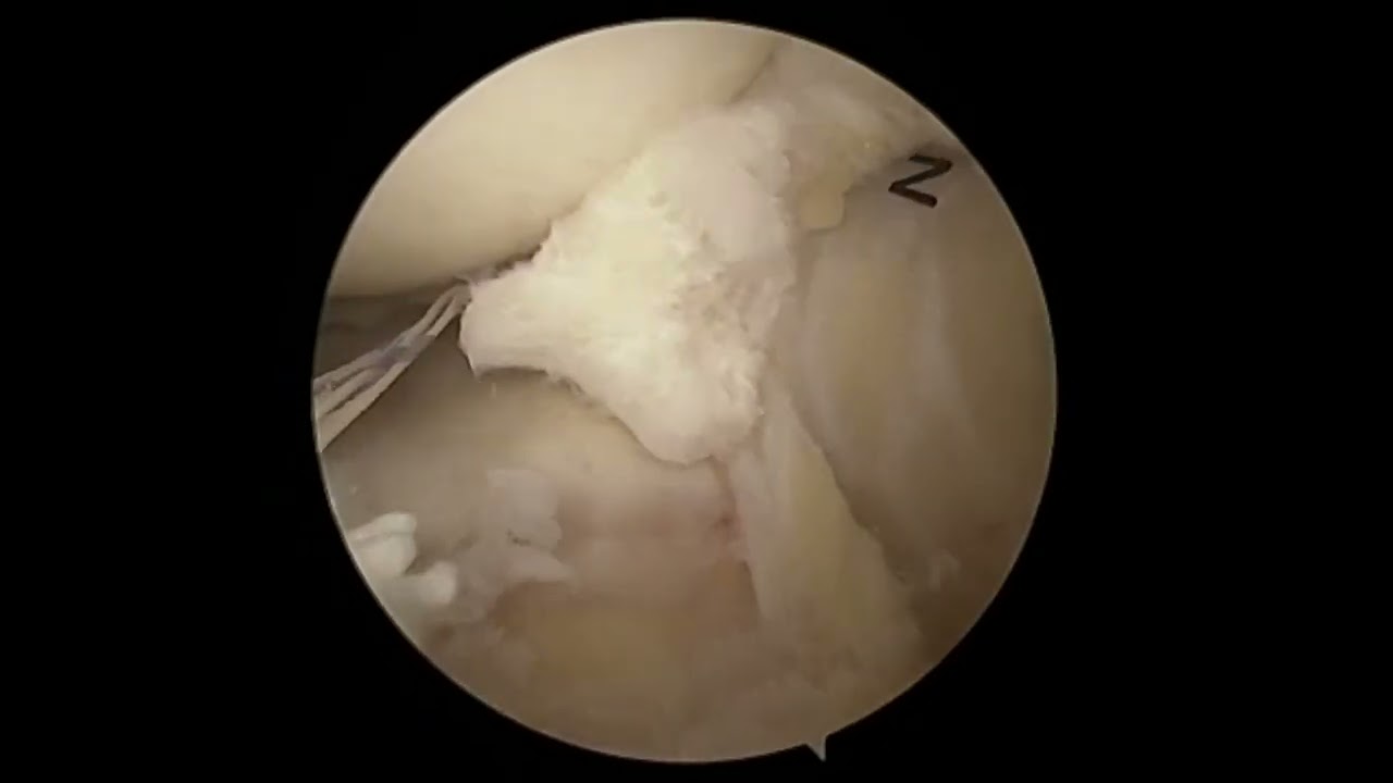Dr. Garcia’s - Anterior Meniscal Root Repair Technique