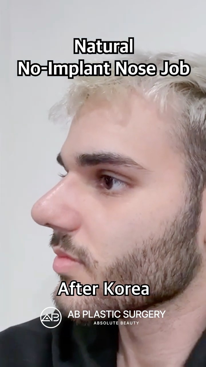Wait.. This Nose Job Used ZERO Implants?!