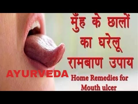 Mouth Ulcer ayurvedic treatment/मुँह के छाले का उपचार/mouth ulcers home remedy Video