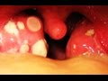 Worlds Greatest Tonsil Stone Removals - YouTube